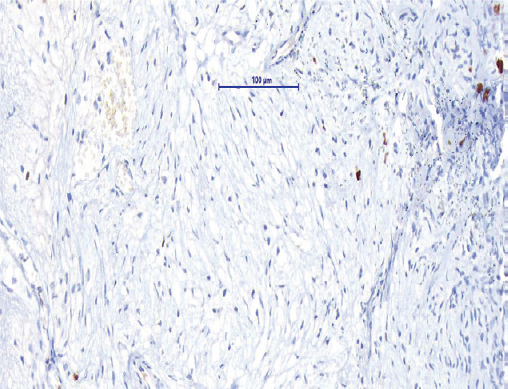 MIB 1 immunohistochemistry staining showing MIB-1 labelling index approximately 2-3 per cent.
